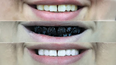 Активированный уголь для зубной эмали