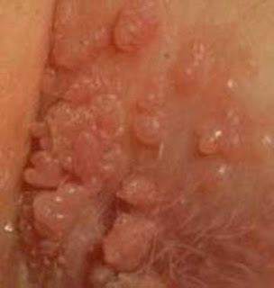 Cara Penularan Virus Hpv