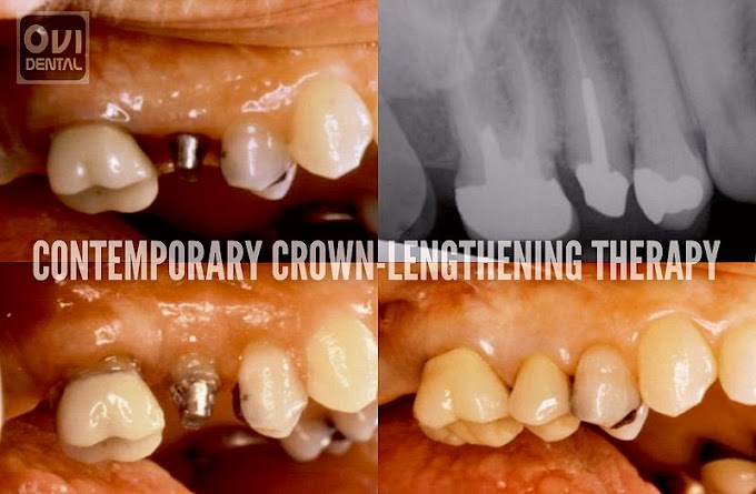 PDF: Contemporary crown-lengthening therapy: A review