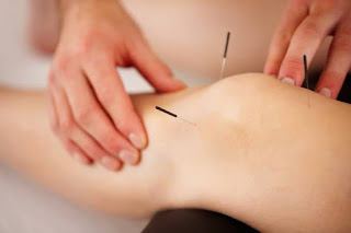 Acupuncture needles in Knee