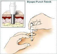 Biyopsi nedir