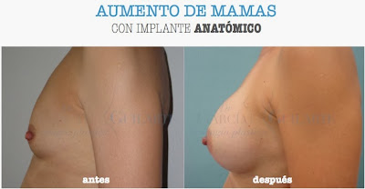 cirujano_plastico_mamoplastia_protesis_pecho