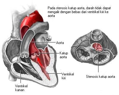 Stenosis katup aorta