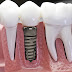 Phục hình răng toàn ham với cấy ghép implant