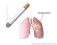 lung cancer