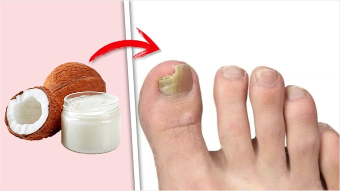 Cómo eliminar los hongos de los pies con aceite de coco