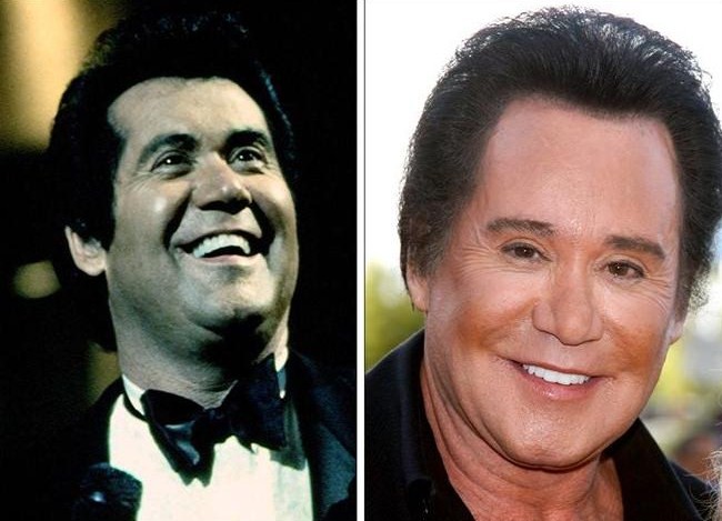 Wayne Newton Plastic Surgery