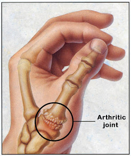 Thumb Arthritis