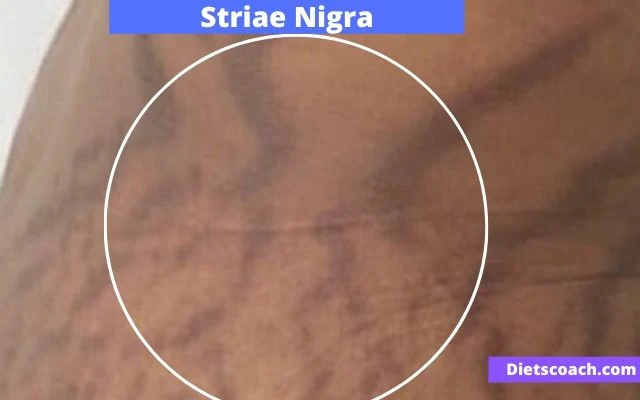 Striae Nigra