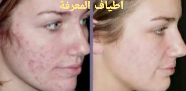 الليزر الكربوني لتفتيح المناطق الحساسة والابط