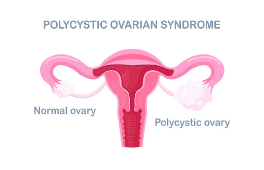 Polycystic ovary