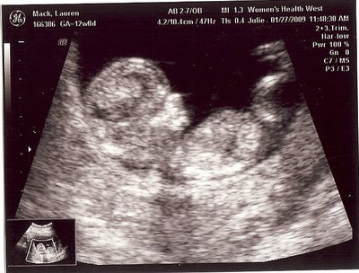 12 5 week ultrasound. 12 5 week ultrasound. 12 Weeks