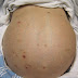 FAHAMU  MATIBABU YA UGONJWA WA TUMBO KUJAA MAJI (EXCESS ABDOMINAL FLUIDS/ASCITES)