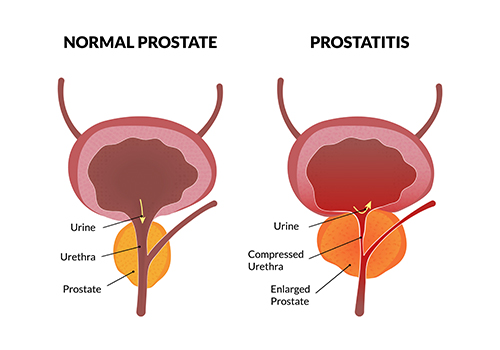 prostatitis