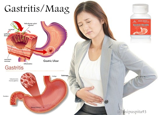 Penyakit Gastritis dan Cara Pengobatannya ~ Blog Kumpulan 