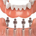 Phương pháp cấy ghép implant