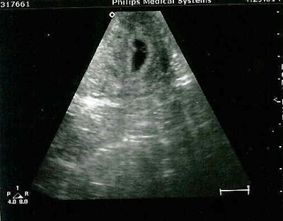  Ultrasound+8+weeks+pregnant