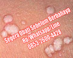 Obat Kutil Kelamin