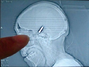 bullet in head