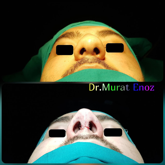 Rhinoplasty in men Istanbul, Male nose job Turkey. Nose aesthetic surgery for men