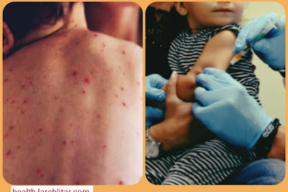 Measles : Symptoms, Causes, Treatment and Prevention