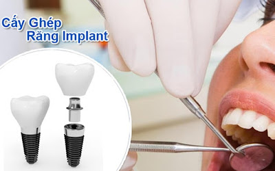 Cấy ghép răng implant ở đâu tốt nhất hiện nay? 3