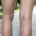 All you need to know about varicose veins