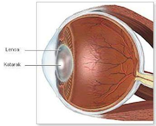 mengatasi katarak