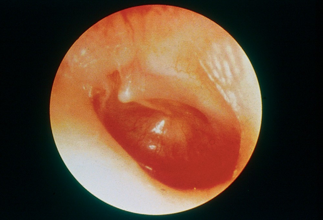  The appearance of the drum in acute otitis media
