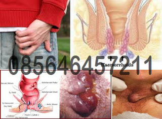 Pengobatan Wasir (Hemoroid) Menahun Yang Sering Kambuh