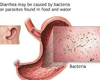 What is Diarrhea? What are the types?  Instant treatment at home.