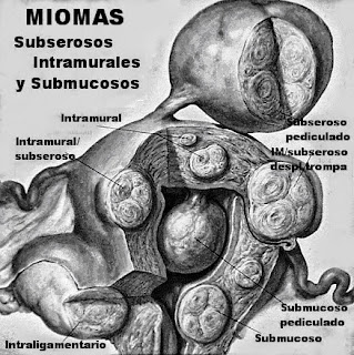  imagen tipos de miomas que es un mioma uterino