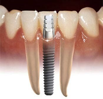 Cấy ghép răng implant có đau không?