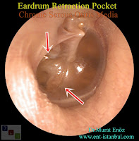 tympanic membrane retraction pocket,Tympanic Membrane Retraction,tympanic membrane atelectasis,Retracted Eardrum,