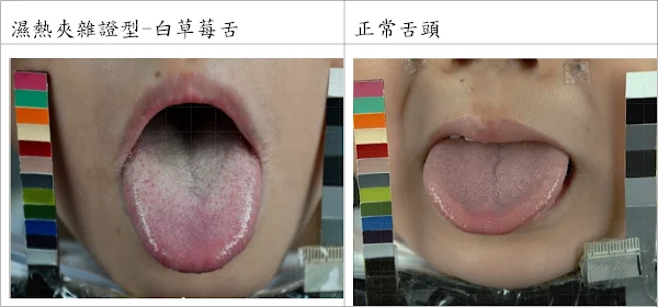 ▲新冠病毒感染後，（圖左）兒童常見舌紅、舌苔白厚膩、舌尖滿布朱點之白草莓舌，顯示體內仍殘留濕熱的表現；圖右為正常舌頭。（中國附醫提供）