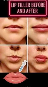 Lip Filler Before and After: What you need to know