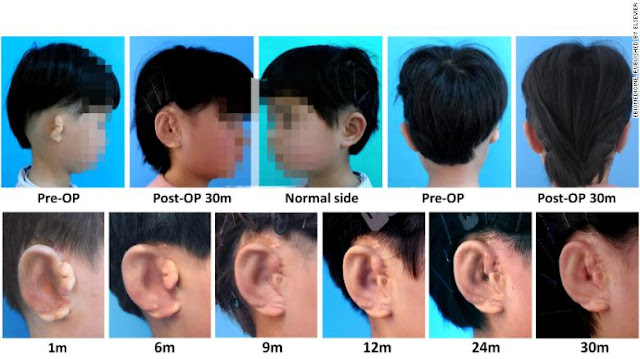 海外ニュース 中国で小耳症の子供ための耳の再生治療に成功 Baha Network