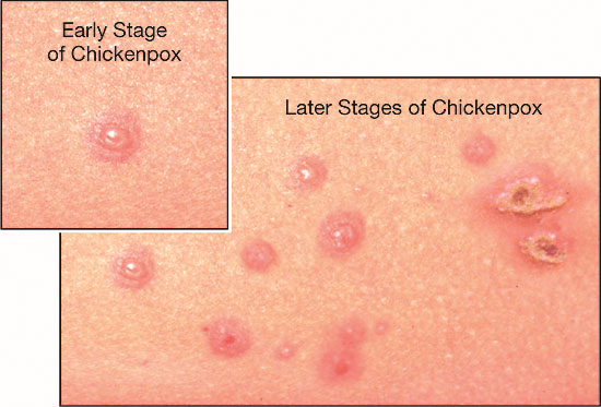 onset of chickenpox. Chickenpox is a common