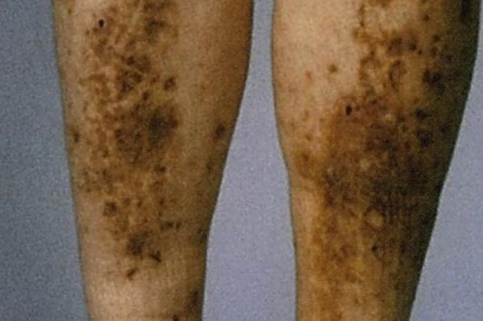 10 Ciri-ciri Diabetes yang Terlihat di Kulit, Termasuk Noda Hitam