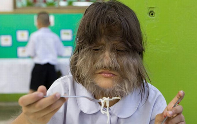 Hypertrichosis 