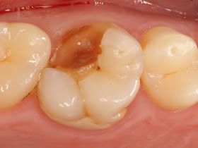 broken tooth porcelain dental crown
