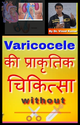 Treatment of Varicocele without Surgery
