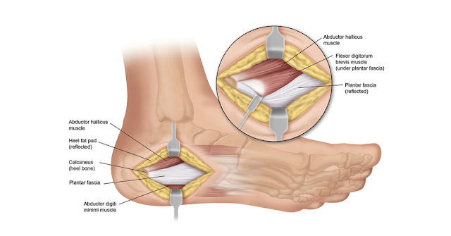 Plantar Fasciitis