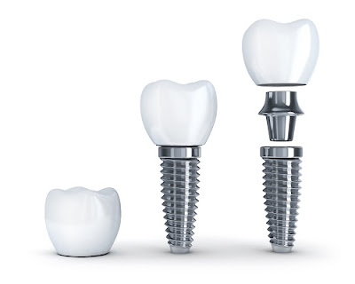 Người 30 tuổi cấy ghép răng implant có đau không? 1