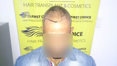 hair transplant in ludhiana