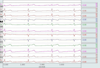 ECG Cardiology