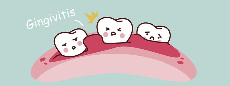 8 Penyakit di dalam mulut yang sering berlaku ( Gingivitis 