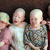 Albinism is beautiful