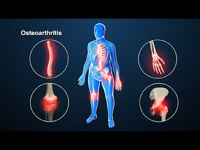 OSTEOARTHRITIS