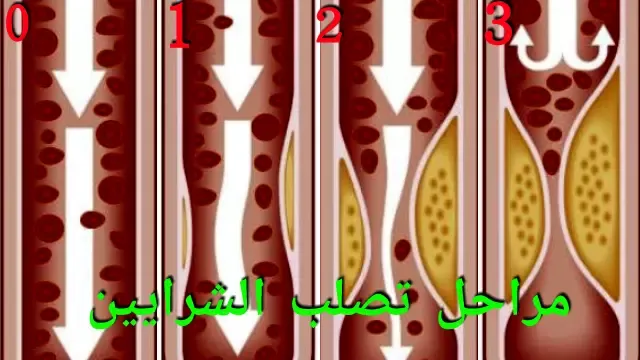 التصلب العصيدي هو مرض شرياني يؤثر على الأوعية الدموية، في جزء كبير منه نتيجة لترسب البروتينات الشحمية التي تحمل الكولسترول